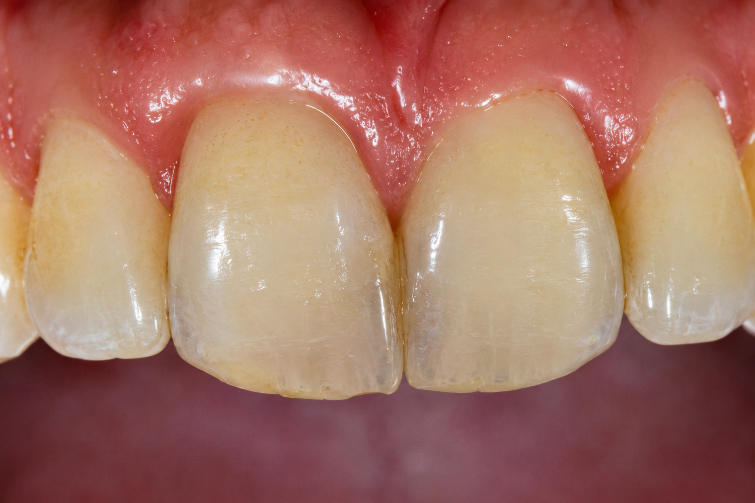 Does Vaping Stain Your Teeth?