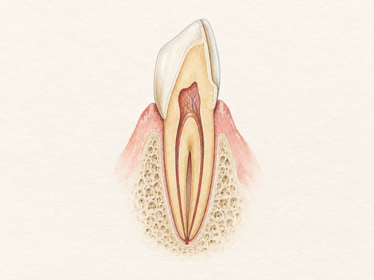 A cutaway front tooth shows a thin veneer shell over its front-facing side, with the enamel underneath reduced, revealing dentin and pulp inside. This makes clear that getting a dental veneer permanently removes some enamel.