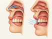 Side-by-side comparison: on the left, closed lips with an open nasal airway and saliva-moistened teeth and gums; on the right, parted lips with airflow drying the enamel and plaque collecting along an irritated gumline.